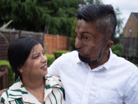 Facial Tumours Won't Stop Growing: Body Bizarre